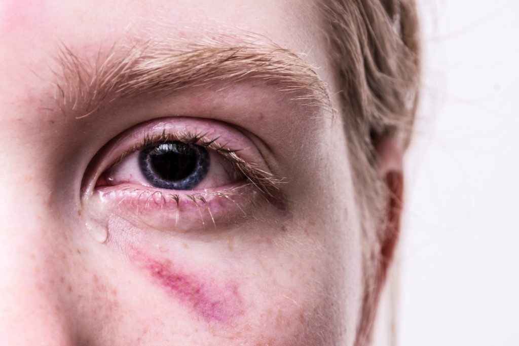 How to Prevent Eye Injuries in the Workplace